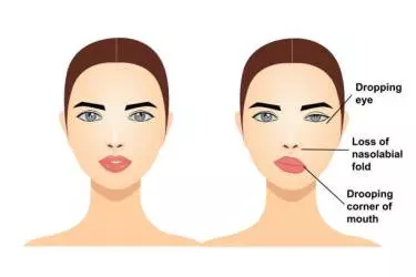 best hospital for facial palsy treatment in purnia, best doctor for facial palsy treatment in purnia, cost of facial palsy treatment in purnia