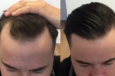 best hospital for hair transplant in Purnia, best doctor for hair transplant in Purnia, cost of hair transplant in Purnia