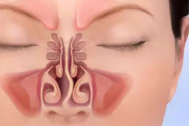 best hospital for septoplasty surgery in purnia, best doctor for septoplasty surgery in purnia, cost of septoplasty surgery in purnia